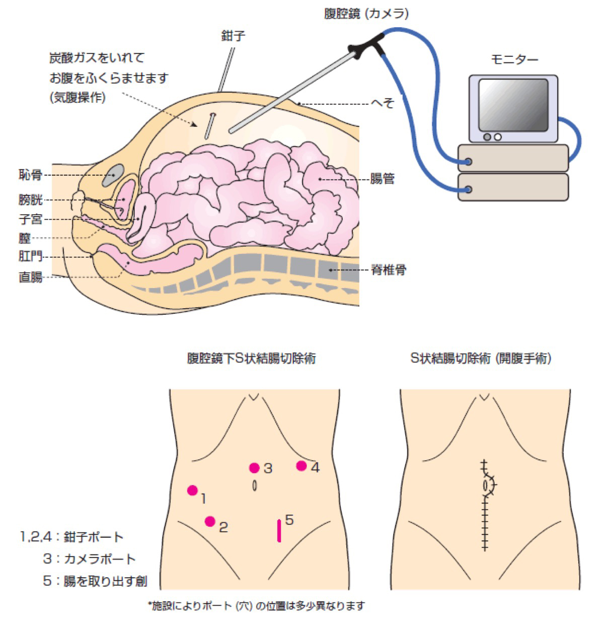 状 結腸 癌 s