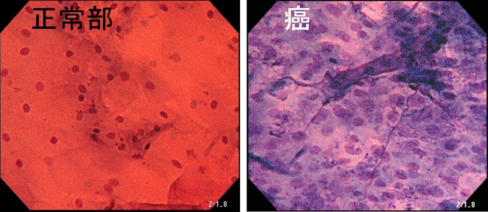 超拡大内視鏡で観察した正常細胞と食道がん細胞